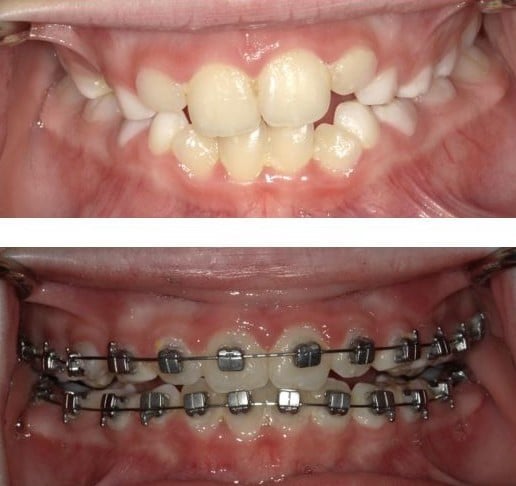 Carriere Bracket Before and After