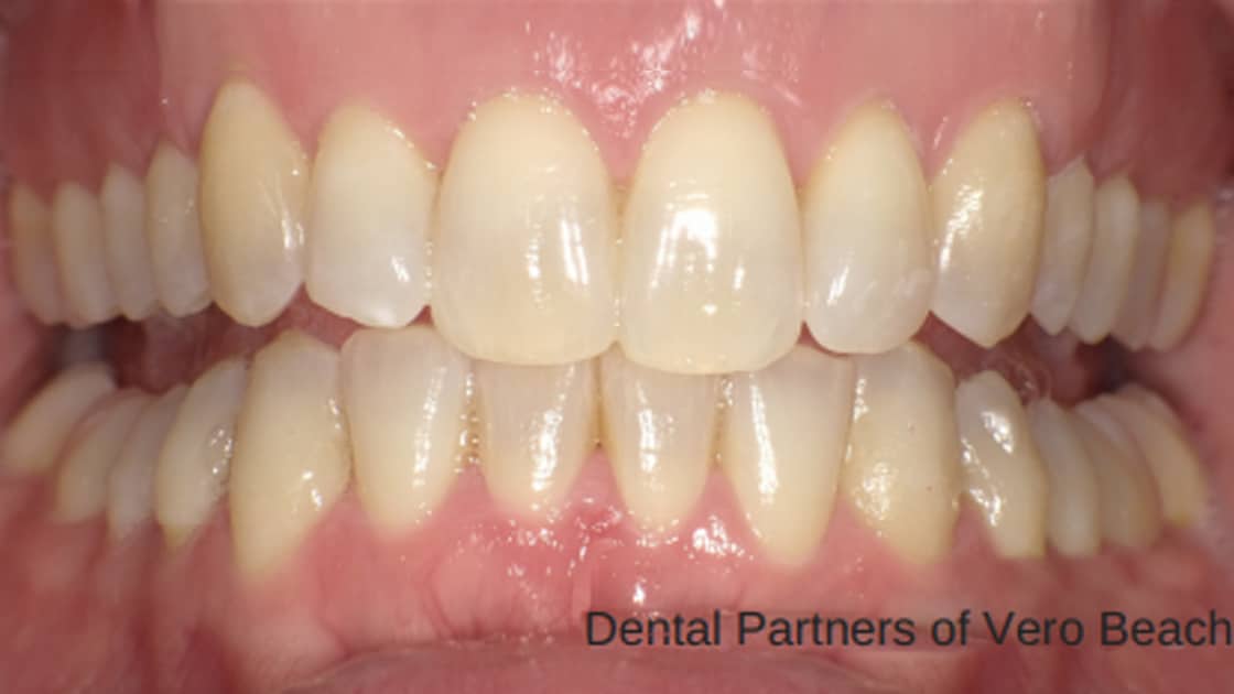 Invisalign Aligners After