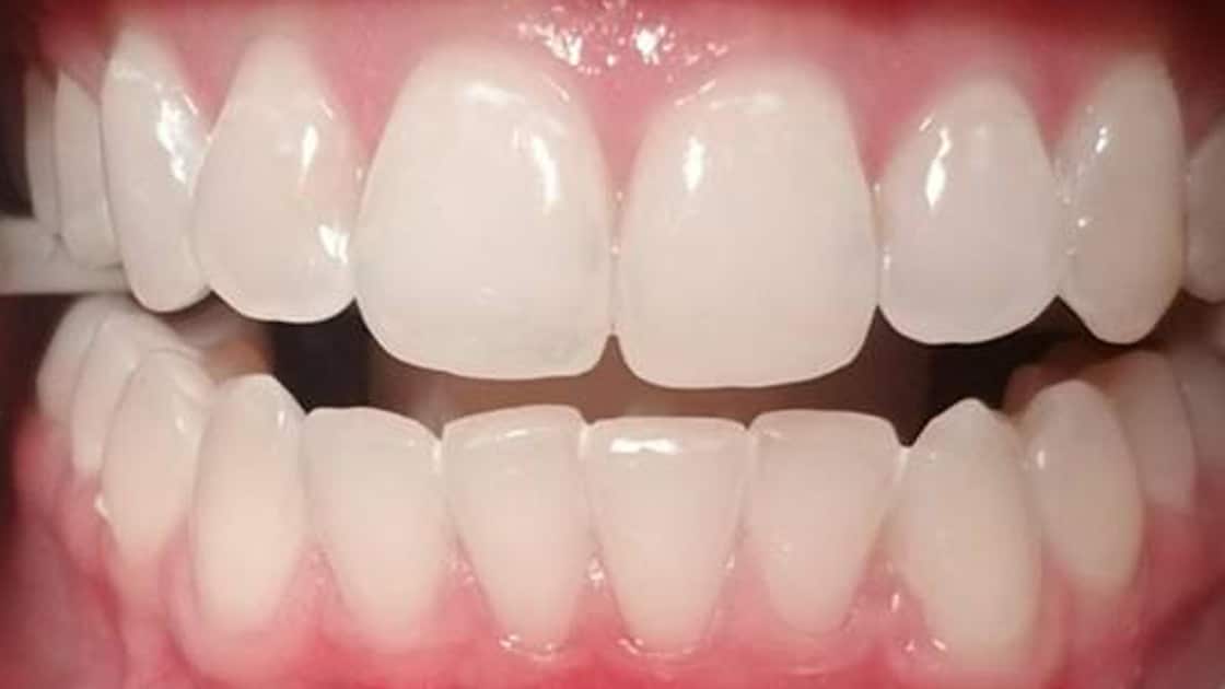 Whitening After Photo