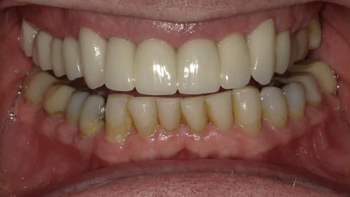 Smile Makover with Crowns1-after