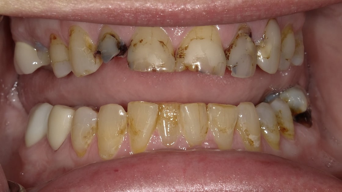 Smile_Restoration_ with Crowns-before