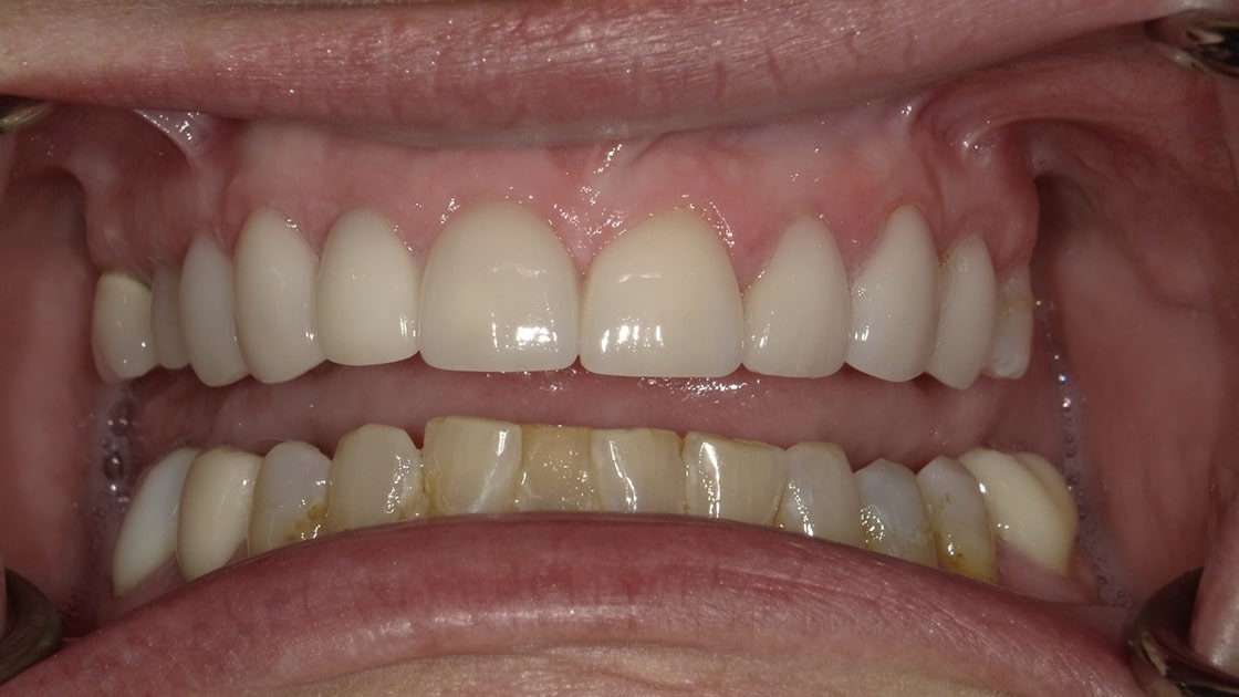 Smile_Restoration_ with Crowns-after