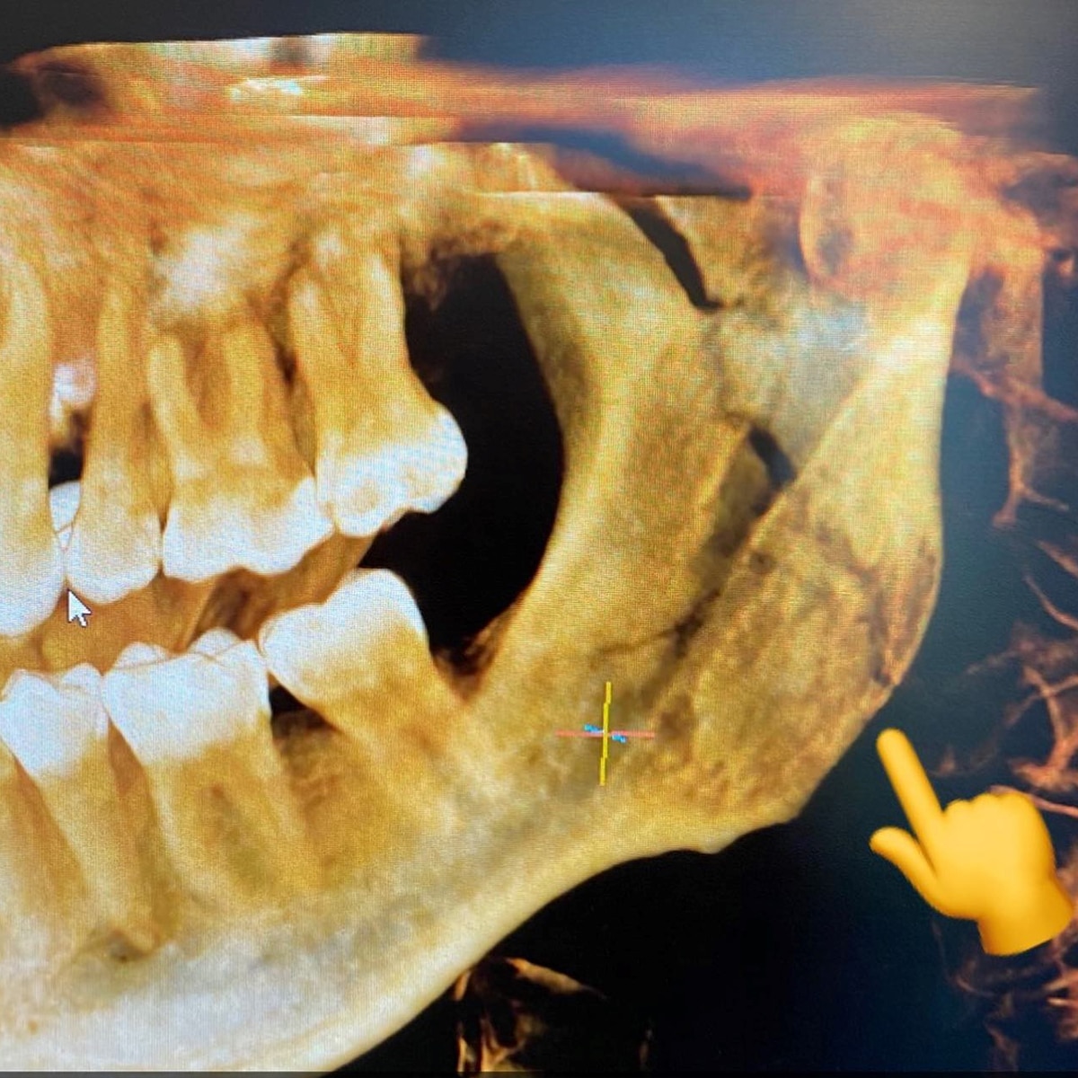 Dental Partners of Vero Beach_ CBCT diagnosed a jaw fracture.jpg