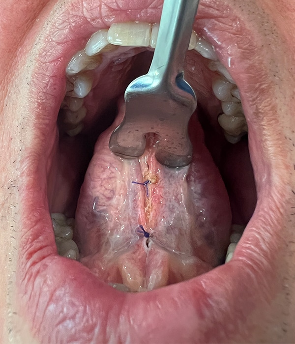 Frenectomy After