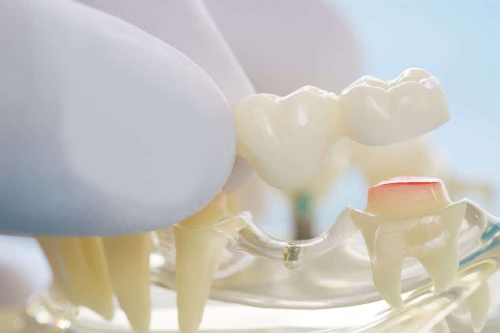 How Long Do Dental Bridges Last?