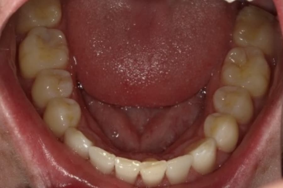 Invisalign Lower Arch After