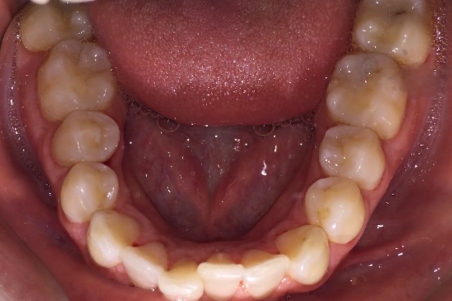 Invisalign Lower Arch Before