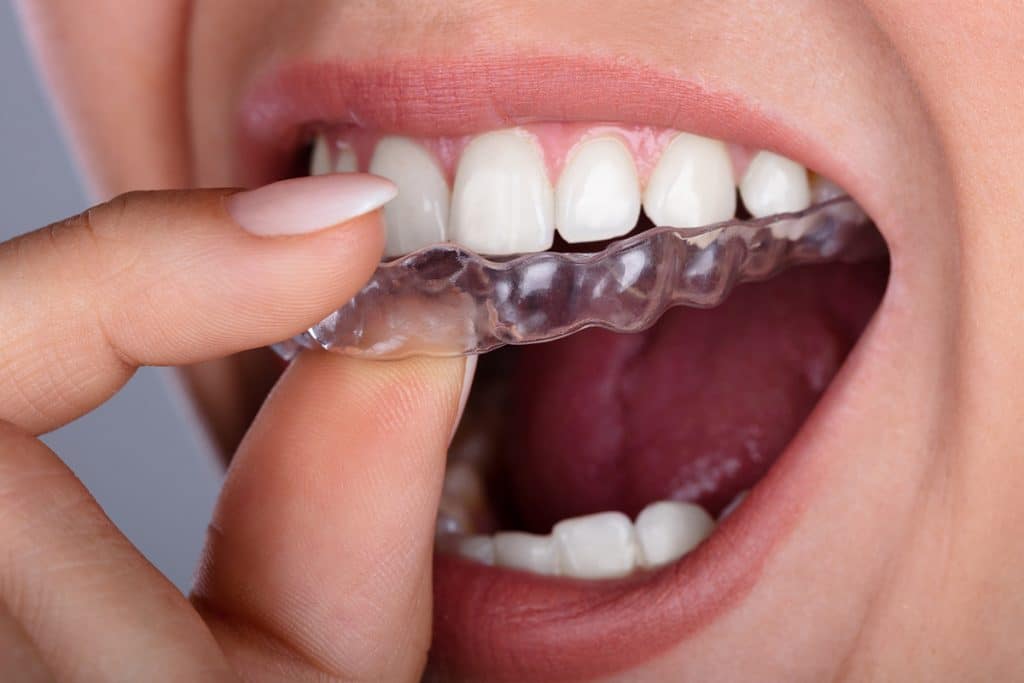 Is Invisalign a Good Option For Teens?