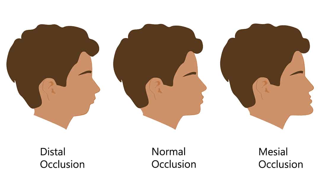Types of Occlusion