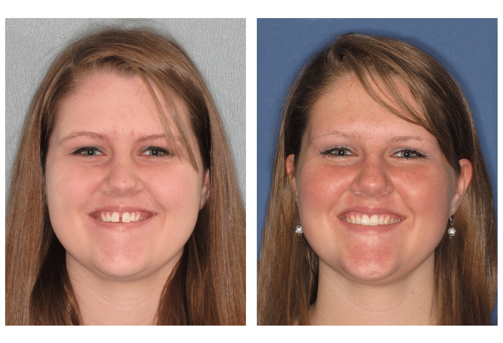 Invisalign Teen Girl Before and After Photo